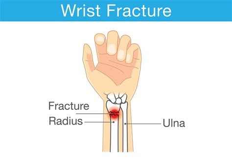 wrist fracture symptoms recovery time